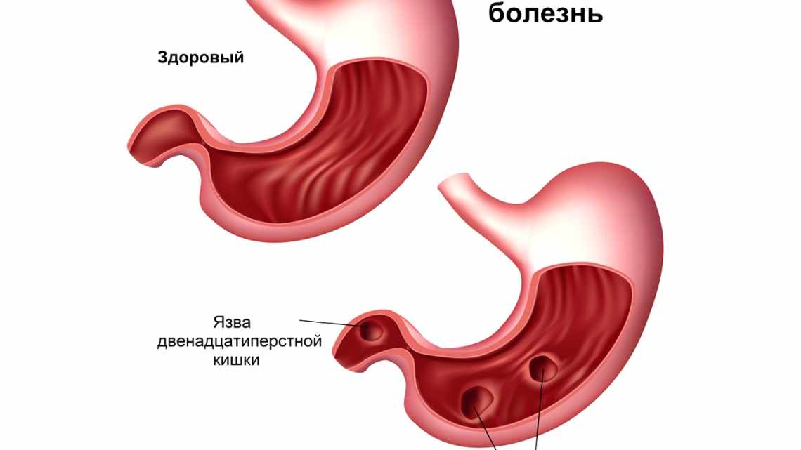 Язвенная болезнь желудка и двенадцатиперстной кишки у ребенка: симптомы и лечение