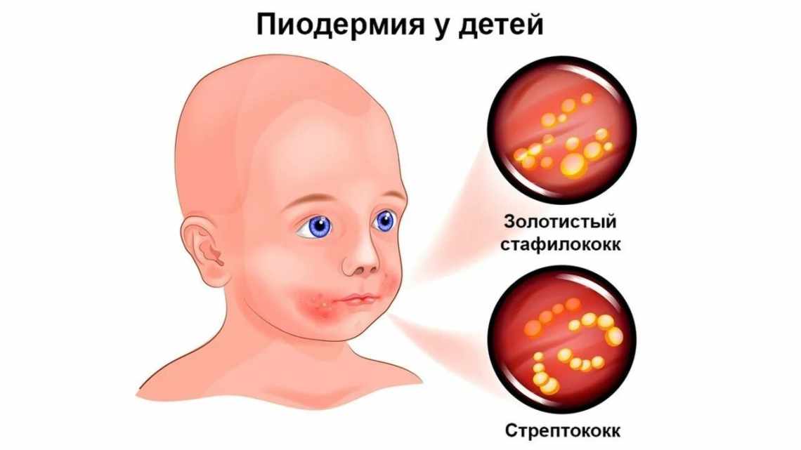 Золотистый стафилококк у новорожденного ребенка: признаки и лечение инфекции в кишечнике, на коже и слизистых