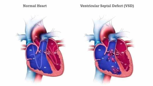 У новорожденного мышечный дефект межжелудочковой перегородки в сердце: каковы последствия и лечение ДМЖП?