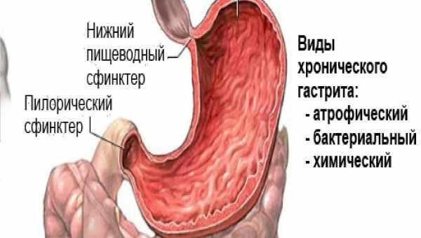 Симптомы острого и хронического гастрита у детей, лечение и профилактика