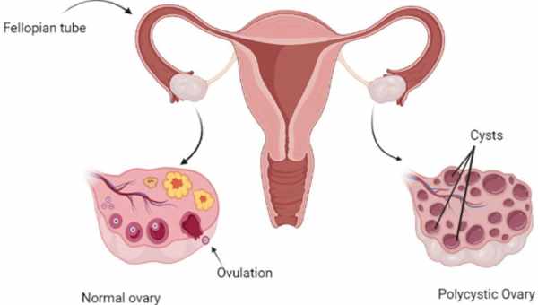 С чего начинается поликистоз яичников