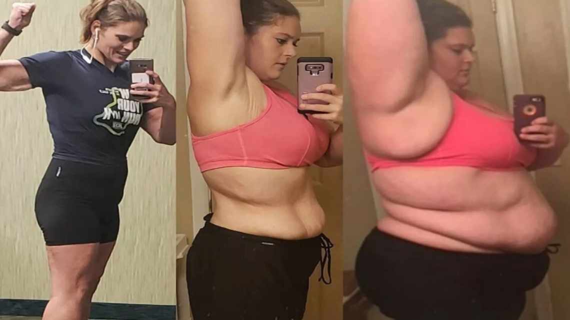 «Весила 100 кг»: как я похудела после резекции желудка