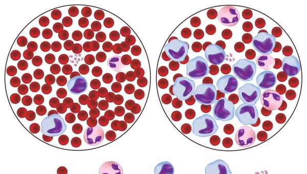 Виды лейкоцитоза