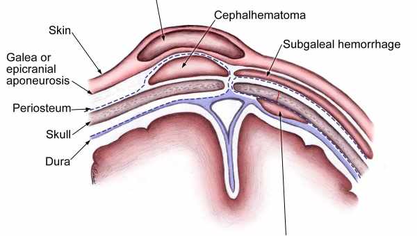 Эпидуральная гематома