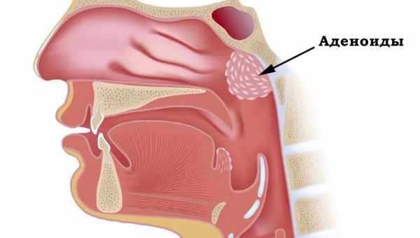 Нужно ли удалять аденоиды?