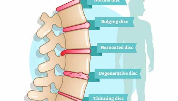 Остеохондроз — причины, симптомы, диагностика, лечение