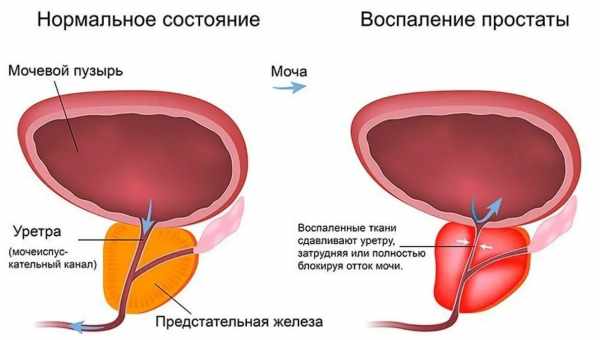 Как проявляется цистит у мужчин: самые первые его симптомы. К кому обращаться с циститом у мужчин, как его лечить