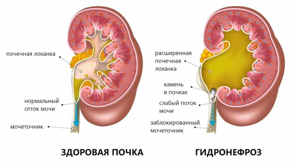 Почечная недостача: Снова о самосборке органов