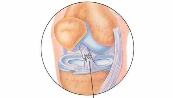 Как ремонтируют порванные связки колена