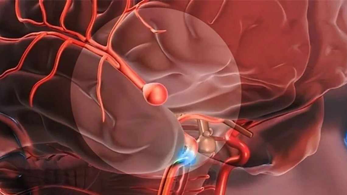 Аневризмы мозга отыщет нейросеть
